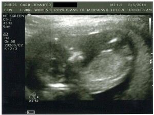 Sonogram at 12.6 Weeks